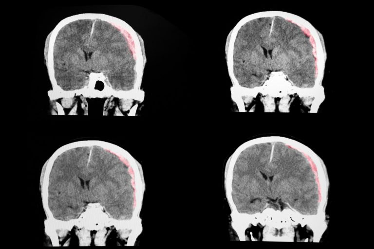 Schwindel nach einem Schädel-Hirn-Trauma