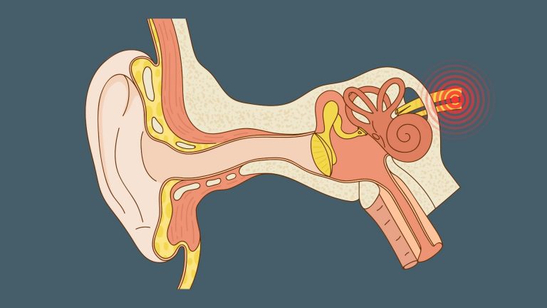 Akute periphere einseitige Vestibulopathie (Neuritis vestibularis): Schlechtere Prognose bei Beteiligung des gesamten Nervs