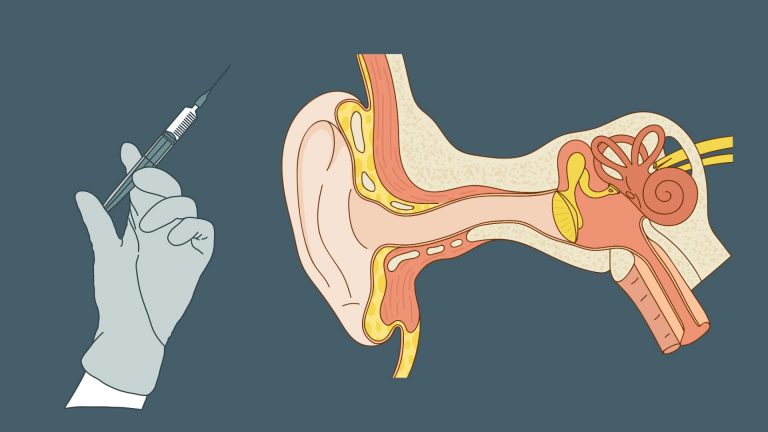 Transtympanales Gentamicin bei Morbus Menière – Wirksamkeit mit Vorbehalt